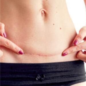 Scars-Stretch marks