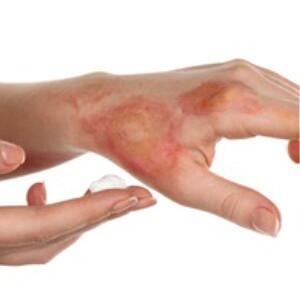 Burns - Radiation dermatitis